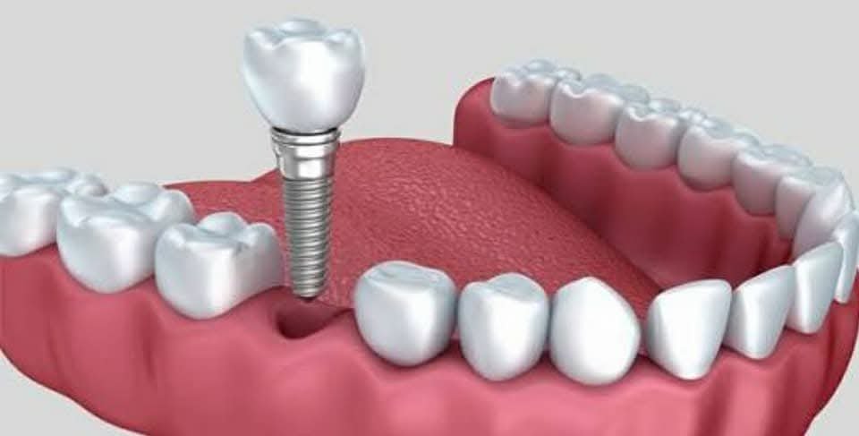 Dental Implants